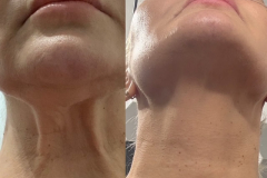 kwas-polimlekowy-stymulatory-tkankowe-mezoterapia