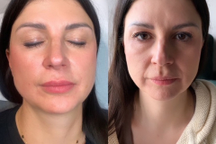 stymulatory-kwas-polimlkowy-mezotrapia